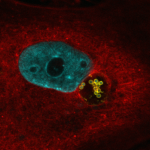 Acinetobacter baumannii clinical strain inside a large vacuole in an epithelial cell